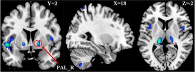 Structural differences among children, adolescents, and adults with attention-deficit/hyperactivity disorder and abnormal Granger causality of the right pallidum and whole-brain